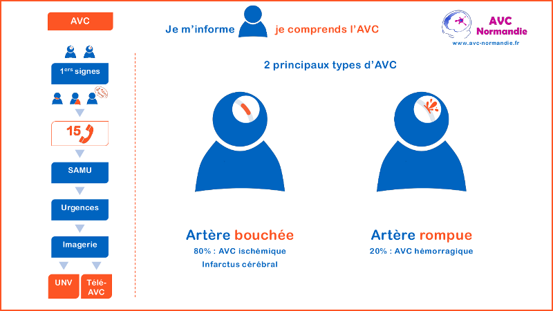 Qu'est-ce qu'un AVC ?